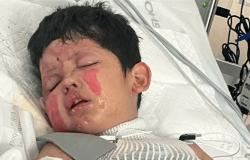 "تجربة علمية" تشعل النار في طفل عمره 7 سنوات.. وشقيقه ينقذه من ألسنة اللهب